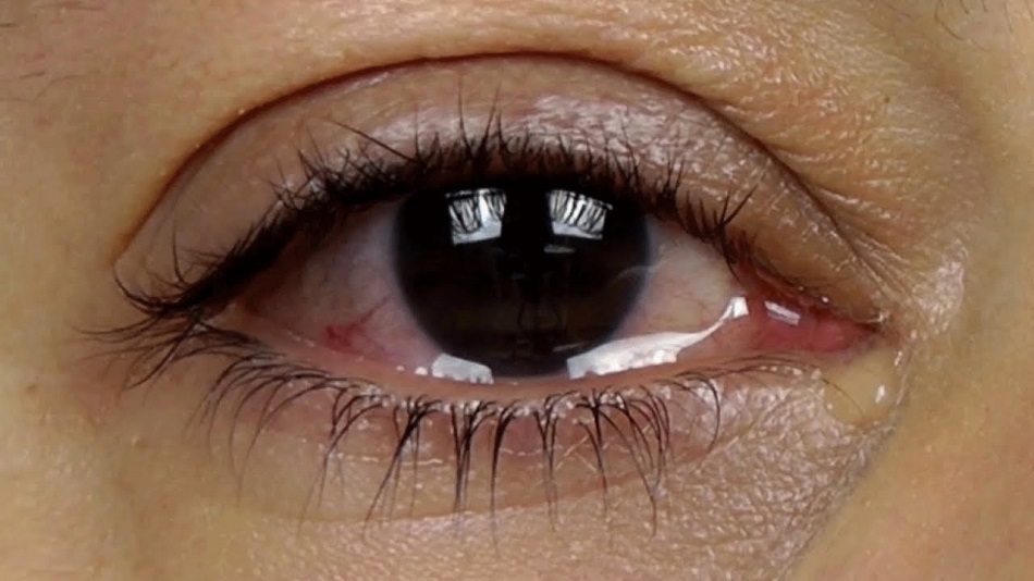 how-to-stop-eyes-from-watering-top-5-causes-and-remedies-for-watery